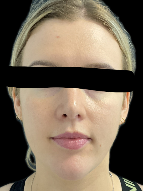 Rhinoplasty Before & After Image