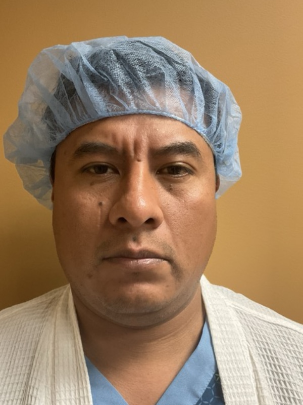 Rhinoplasty Before & After Image