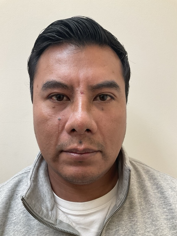 Rhinoplasty Before & After Image