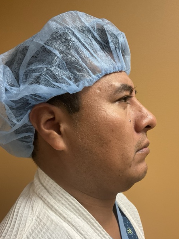 Rhinoplasty Before & After Image
