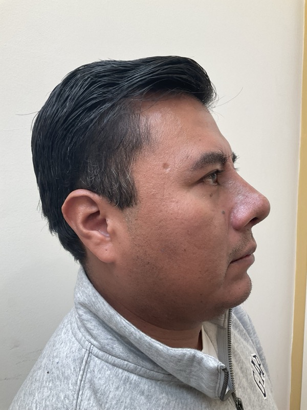 Rhinoplasty Before & After Image