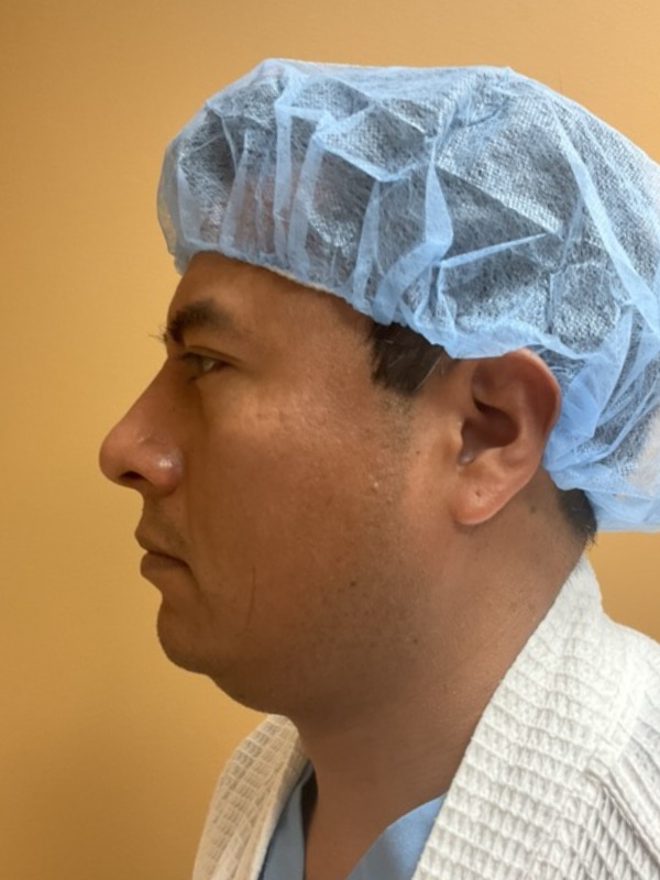 Rhinoplasty Before & After Image