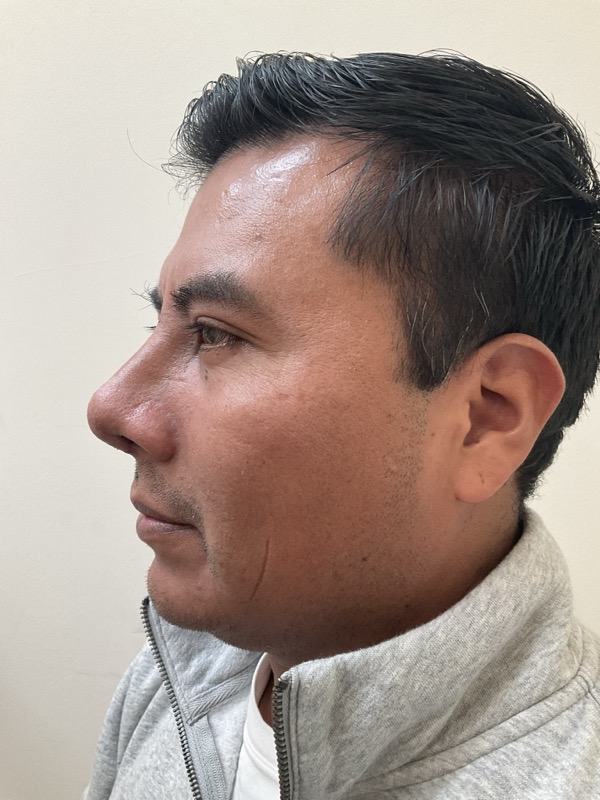 Rhinoplasty Before & After Image