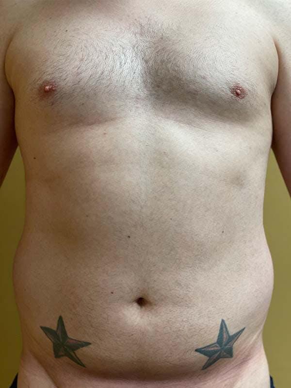 Vaser Liposuction Before & After Image
