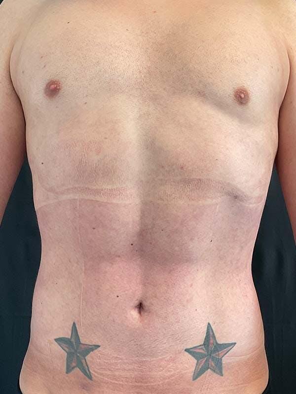 Vaser Liposuction Before & After Image