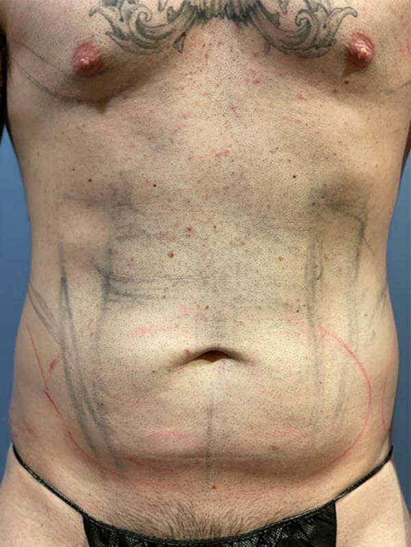 Vaser Liposuction Before & After Image