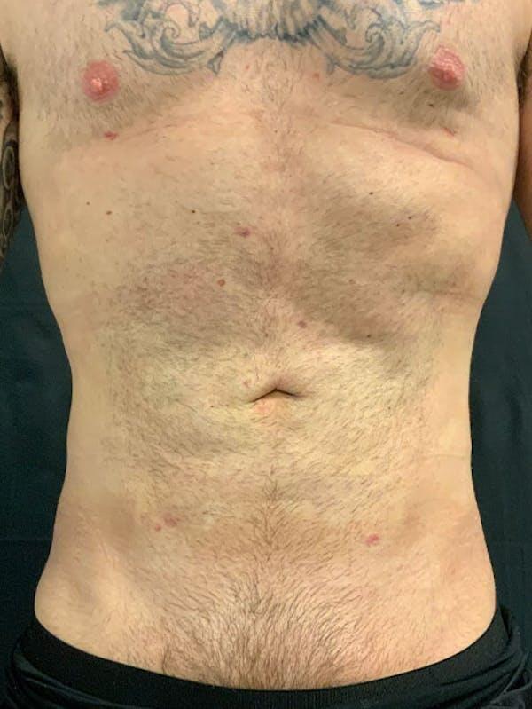 Vaser Liposuction Before & After Image