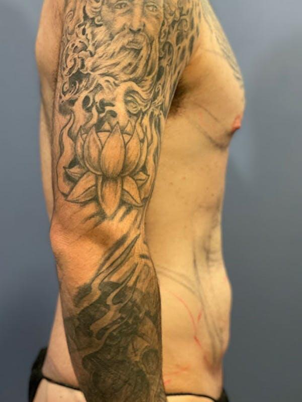 Vaser Liposuction Before & After Image