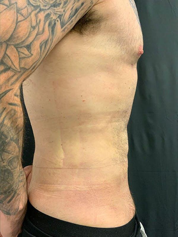 Vaser Liposuction Before & After Image