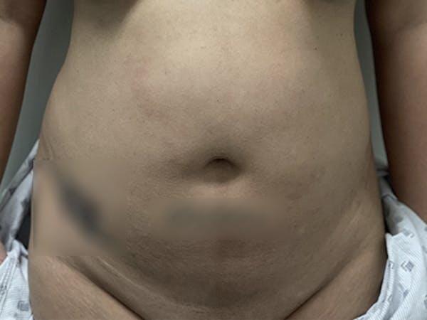 Abdomen Liposuction Before & After Image