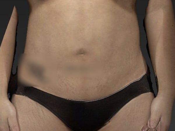 Abdomen Liposuction Before & After Image