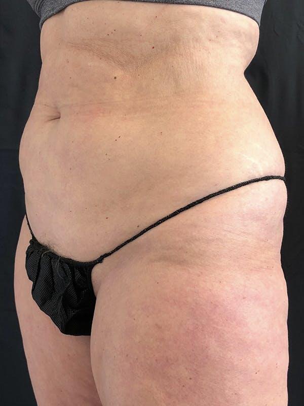 Vaser Liposuction Before & After Image