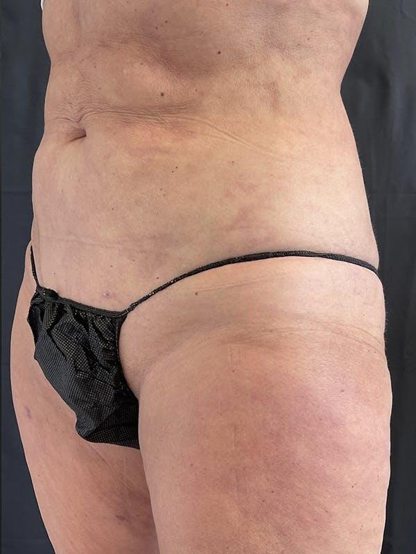 Vaser Liposuction Before & After Image