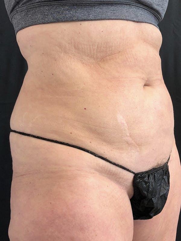 Abdomen Liposuction Before & After Image