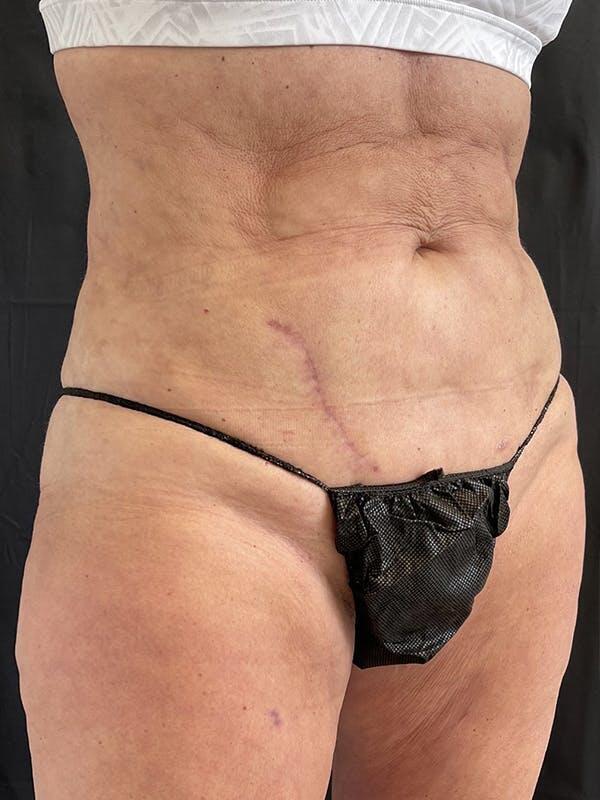 Vaser Liposuction Before & After Image