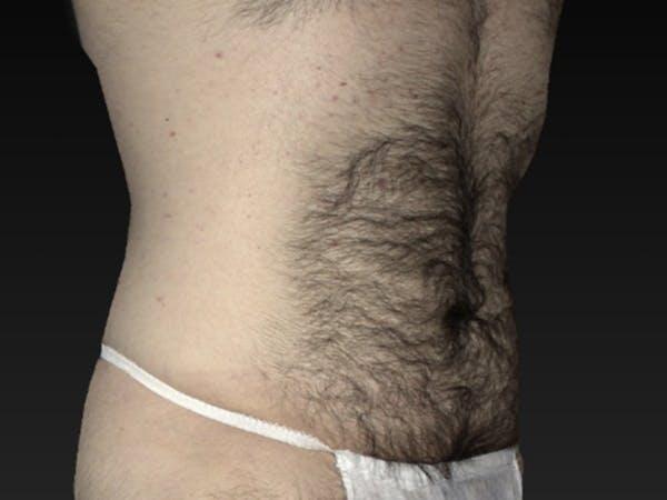 Vaser Liposuction Before & After Image