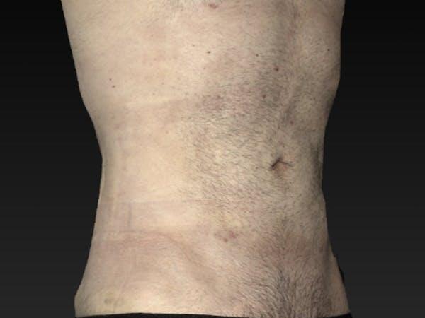 Abdomen Liposuction Before & After Image