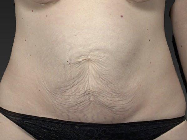 Abdomen Liposuction Before & After Image