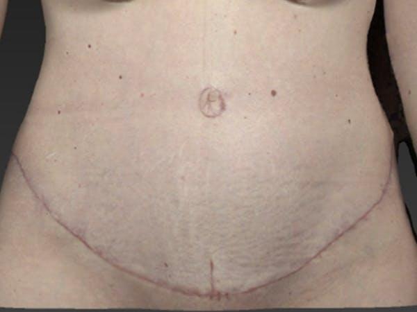 Vaser Liposuction Before & After Image