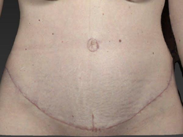 Abdomen Liposuction Before & After Image