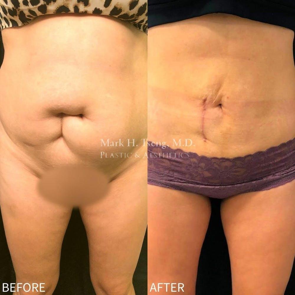 Abdomen Liposuction Before & After Image