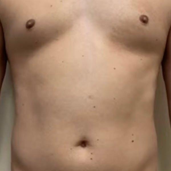 Abdomen Liposuction Before & After Image