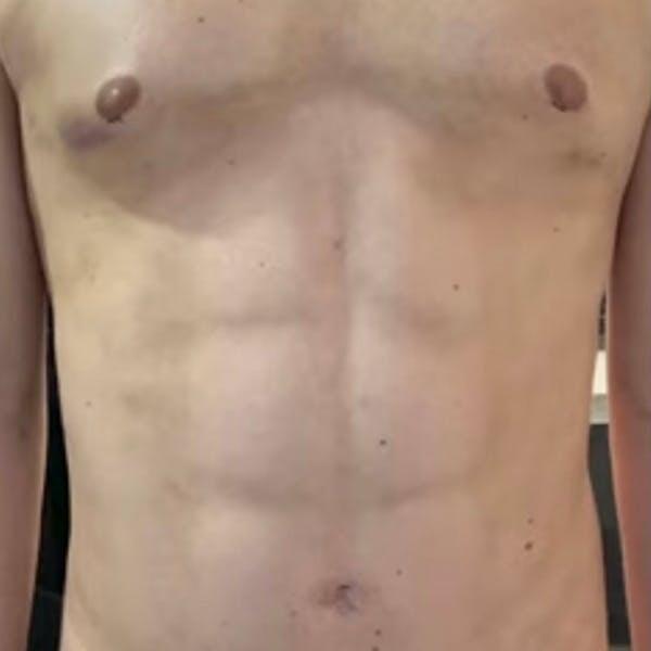 Abdomen Liposuction Before & After Image