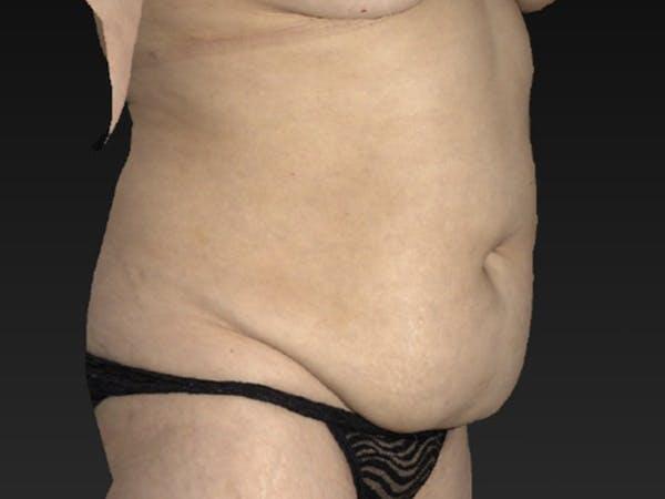 Abdomen Liposuction Before & After Image