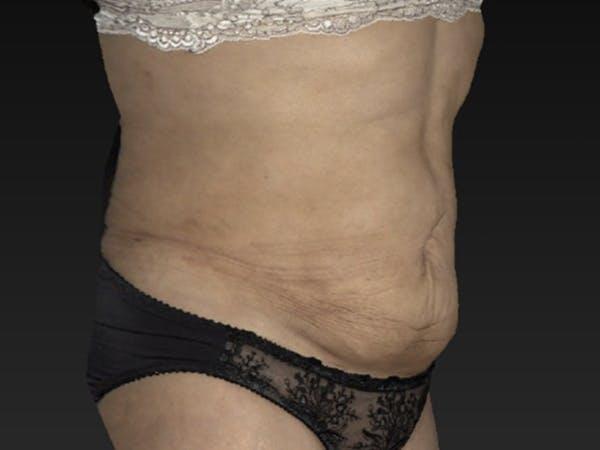 Abdomen Liposuction Before & After Image