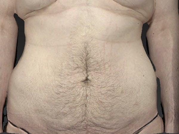 Vaser Liposuction Before & After Image