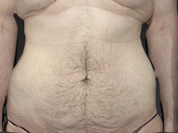 Abdomen Liposuction Before & After Image