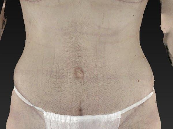 Abdomen Liposuction Before & After Image