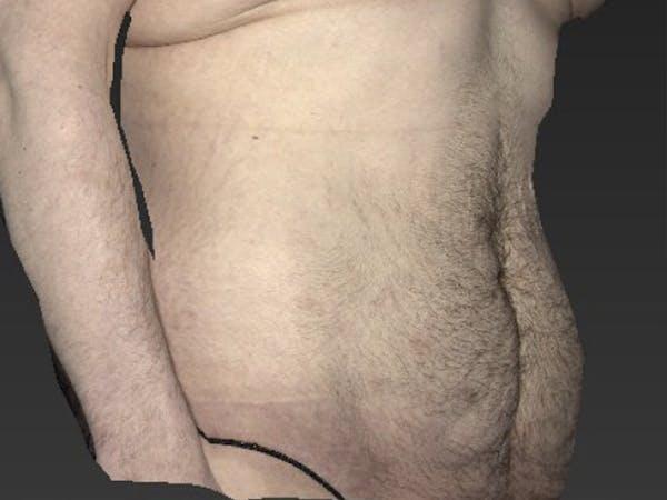 Vaser Liposuction Before & After Image