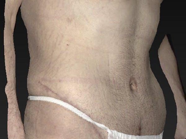 Abdomen Liposuction Before & After Image