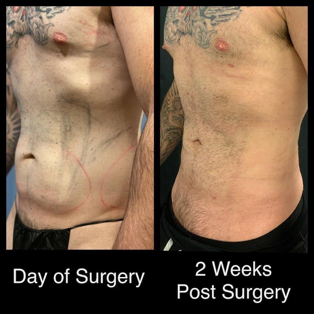 Abdomen Liposuction Before & After Image