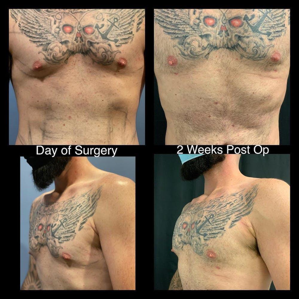 Vaser Liposuction Before & After Image