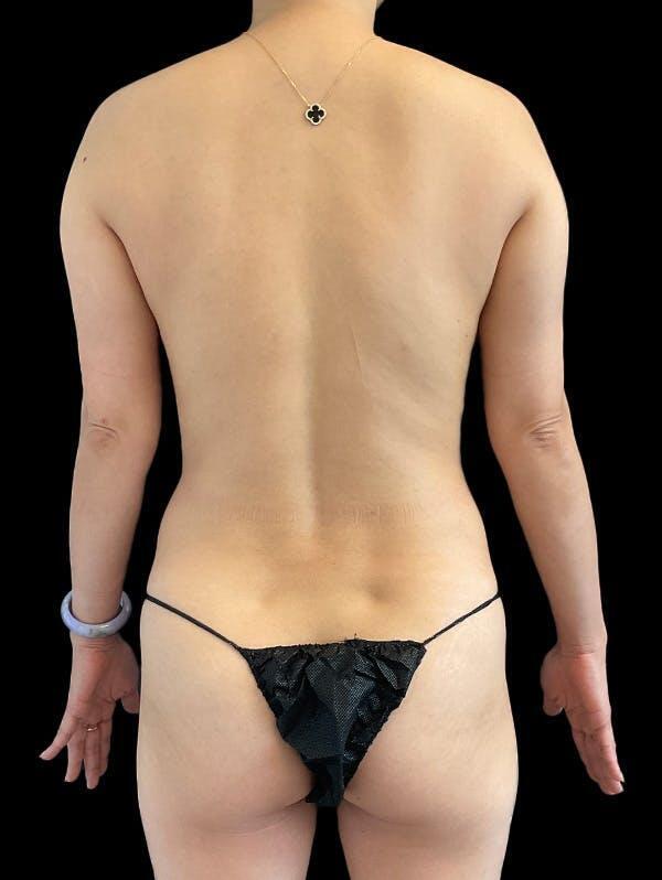 Vaser Liposuction Before & After Image