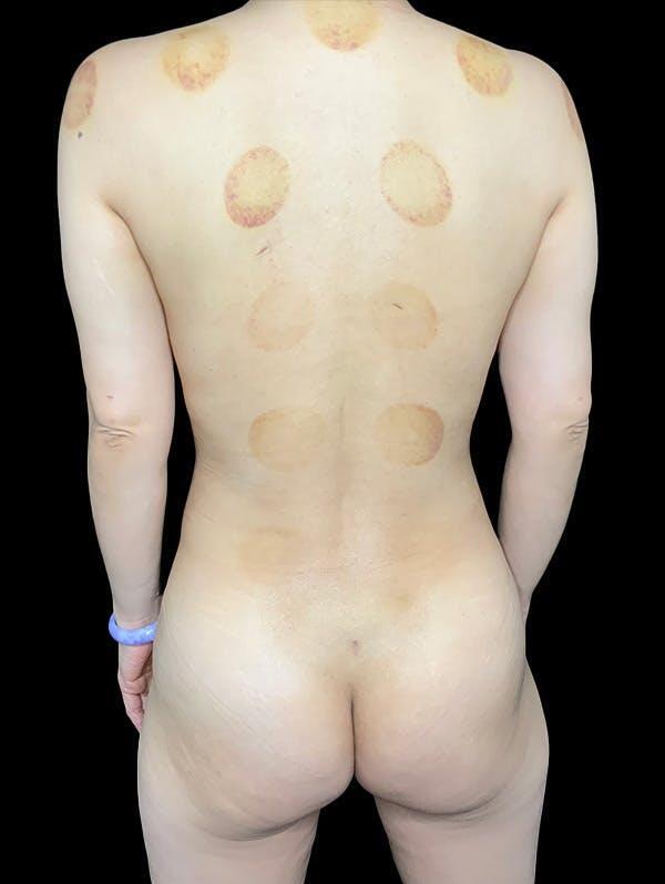 Vaser Liposuction Before & After Image