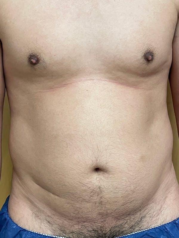 Abdomen Liposuction Before & After Image