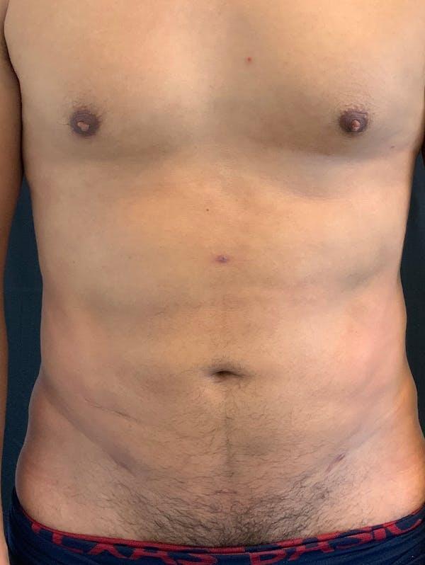 Abdomen Liposuction Before & After Image