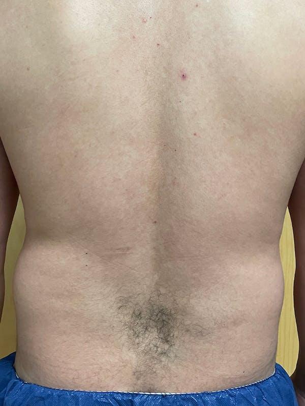 Vaser Liposuction Before & After Image