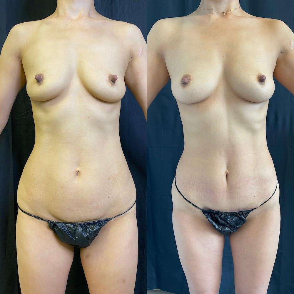 Vaser Liposuction Before & After Image