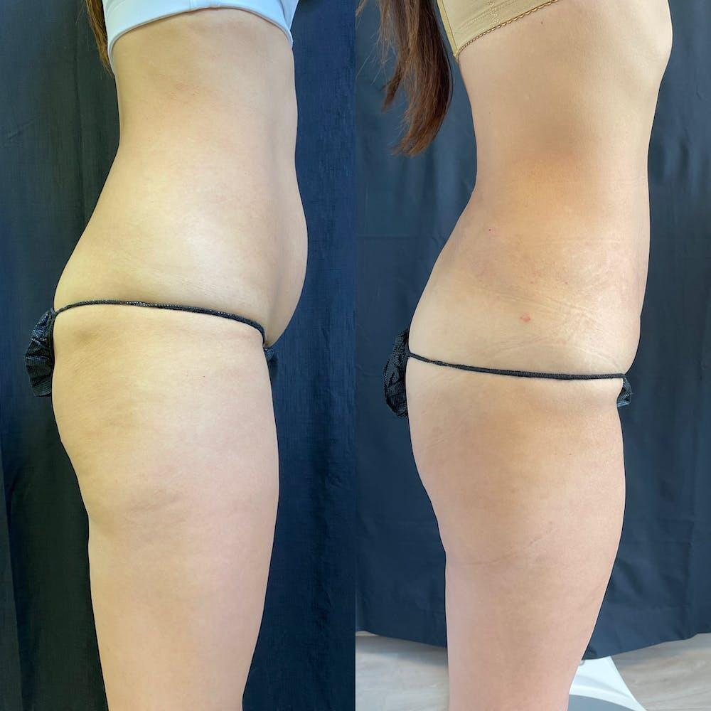 Vaser Liposuction Before & After Image