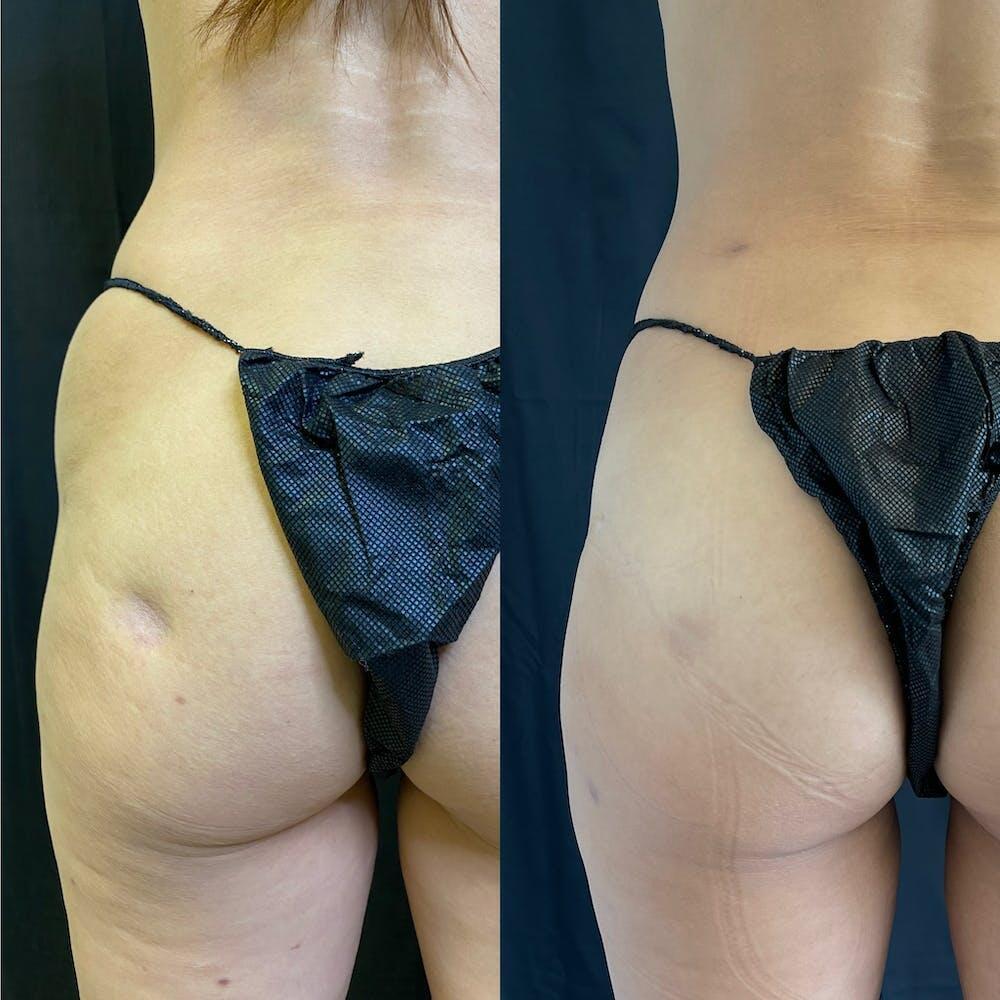 Abdomen Liposuction Before & After Image