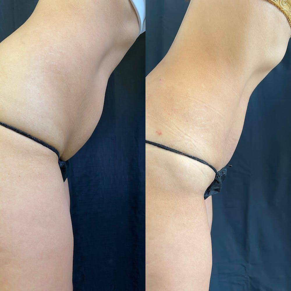 Vaser Liposuction Before & After Image