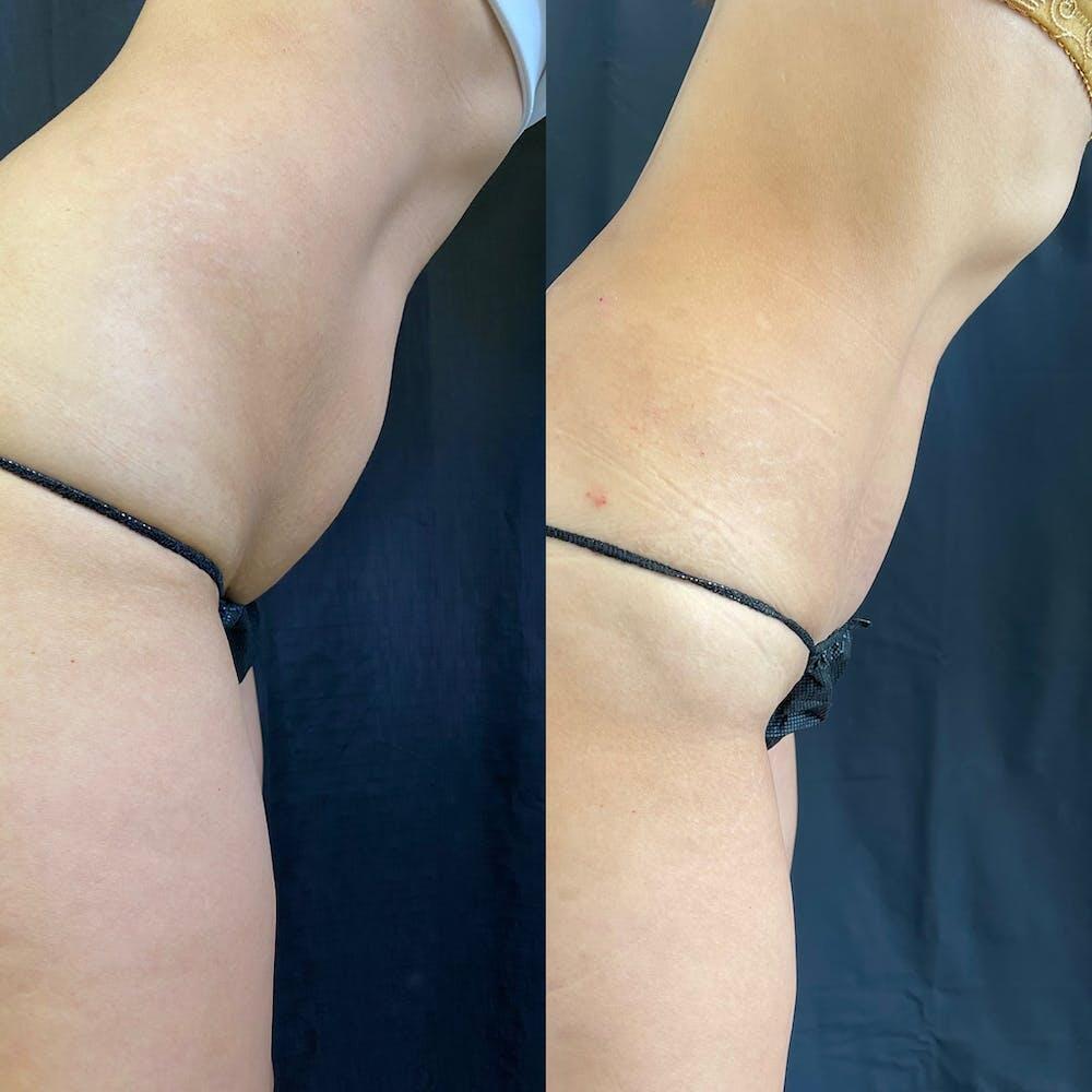 Abdomen Liposuction Before & After Image