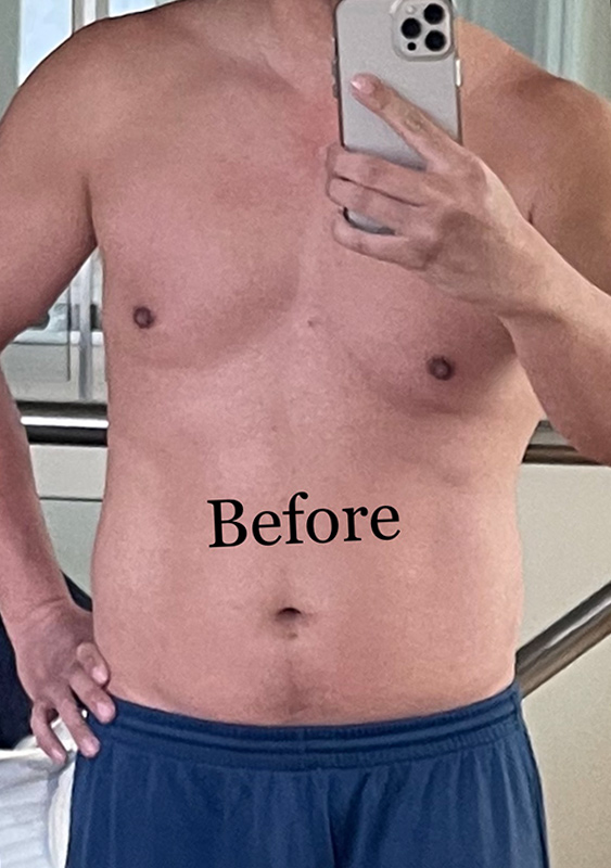 Abdomen Liposuction Before & After Image