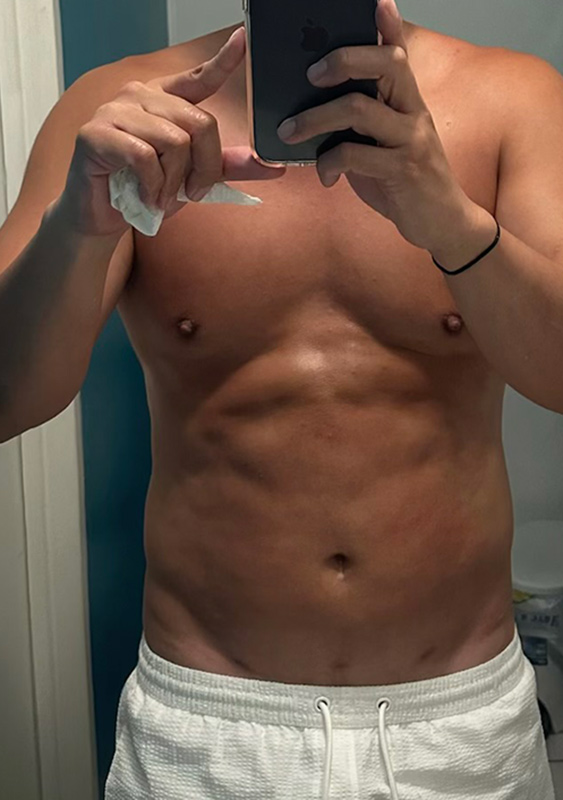 Vaser Liposuction Before & After Image