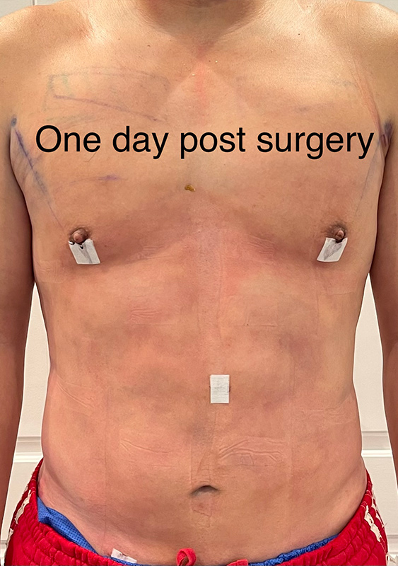 Abdomen Liposuction Before & After Image