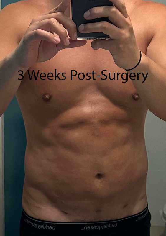 Vaser Liposuction Before & After Image